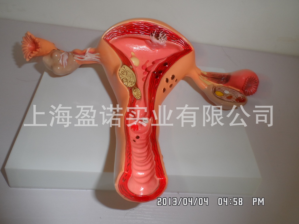 子宫,卵巢病理模型 生殖医药礼品模型