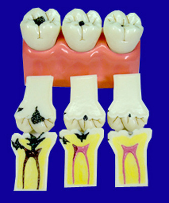 牙齿模型_专业生产口腔模型\/牙齿模型\/4倍龋齿