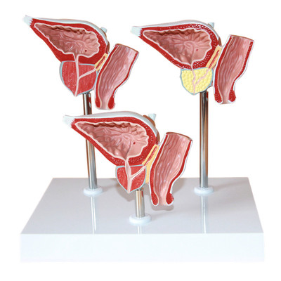 星寿品牌人体前列腺病变模型 前列腺癌症模型泌尿系统模型